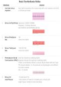 Basic Dysrhythmia-Relias Exam &vert; 29 Questions and Answers