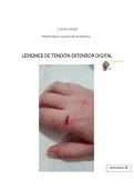 notas r&aacute;pidas - lesiones tend&oacute;n extensor digital mano