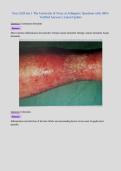 PACKAGE DEAL FOR NURS 5220 EXAMS with  UPDATED Questions and 100&percnt; Verified Answers 