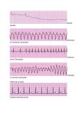 ACLS Pretest Study Notes and Key Interventions for Cardiac Emergencies