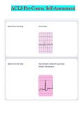 ACLS Pre-Course Self-Assessment &ndash; Complete Questions and Answers on ECG Rhythm Recognition&comma; Cardiac Arrest&comma; Bradycardia&comma; Tachycardia&comma; Stroke&comma; and Acute Coronary Syndromes&NewLine;&NewLine;