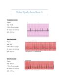 Relias Dysrhythmia Basic A Exam &ndash; Questions and Answers&comma; Cardiac Rhythms & ECG Study Guide