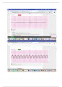 StaRN EKG Test (Lethal Rhythms)