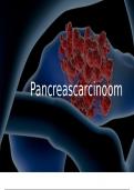Pancreascarcinoom