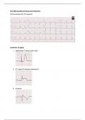 ECG assesment of myocardial ischemia and myocardial infarction