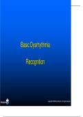 Basic Dysrhythmia Recognition