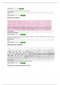 Electrocardiogram EKG Clep Test (Actual Exam) (100% Correct Answers) (Graded A+)