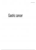 Gastric cancer