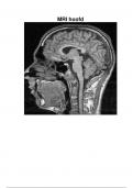 MRI hoofd