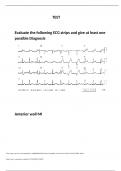  PROJECT MA pioneers ECG_TEST Evaluate the following ECG strips and give at least one possible Diagnosis