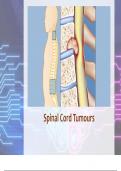 Spinal Cord Tumours