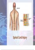 Spinal Cord Injury with complete solution