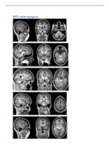 MRI oefenopgave (uitwerkingen) Hersenen En Aansturing (H&A) 