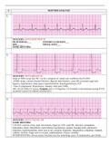 NURSING NUR 2222 EKG updated; RYTHM ANALYSIS | Already GRADED A.