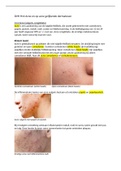 Samenvatting H14 Acne en op acne gelijkende dermatosen