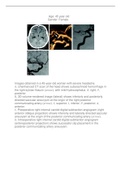 Cerebral Aneurysm case report with images