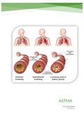 astma 