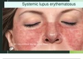 Systemic Lupus Erythematosus