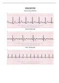 Prophecy EKG Strips|Relias Dysrhythmia Basic Test A|EKG Strips