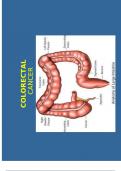 COLORECTAL CANCER- Symptoms&comma; stages&comma; causes&comma; and treatmen