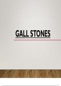 Gall stones &sol; Cholelithiasis 