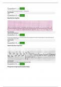 EKG Clep Test &lpar;50&rpar; Questions and Answers Verified&period; A&plus; Graded&period;