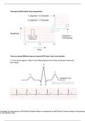 Five Steps to Interpreting an EKG Rhythm Strip